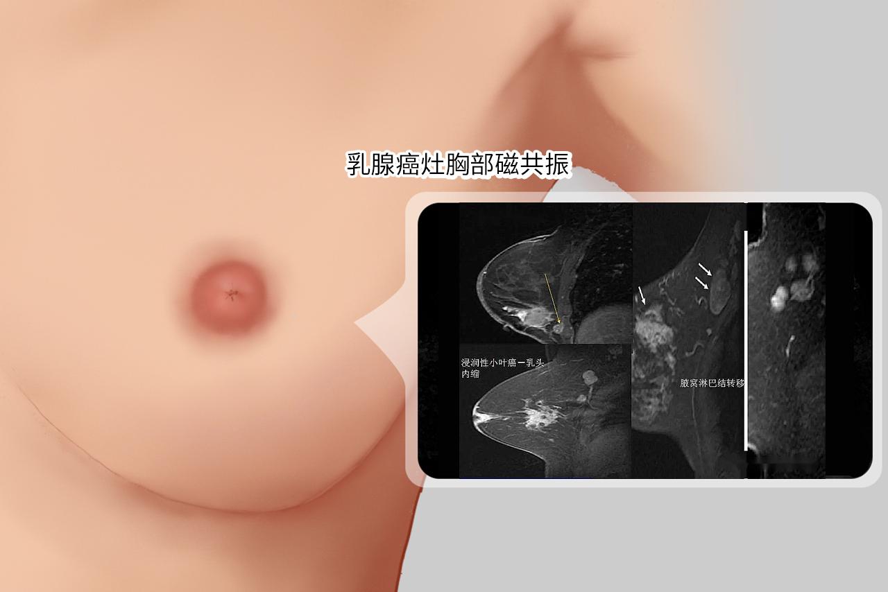乳腺癌灶胸部磁共振图片（乳腺癌灶胸部磁共振图片高清）