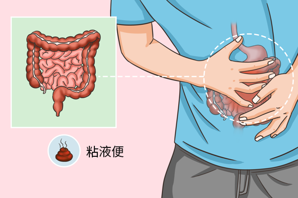 溃疡性结肠炎粘液便图片（溃疡性结肠炎粘液脓血便图片）