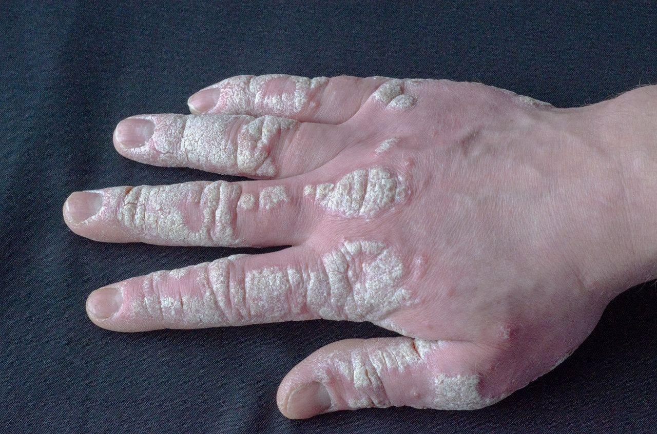 手指银屑病关节炎图片（手指银屑病关节炎图片）