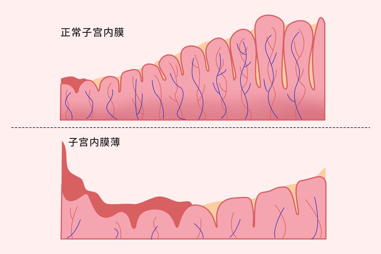 子宫内膜薄图片 子宫内膜薄的明显症状