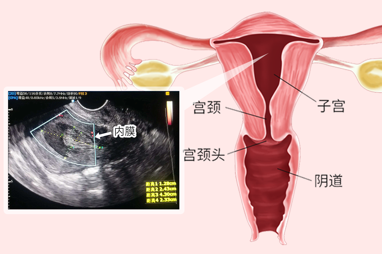 子宫内膜彩超图解 子宫内膜彩超怎么看