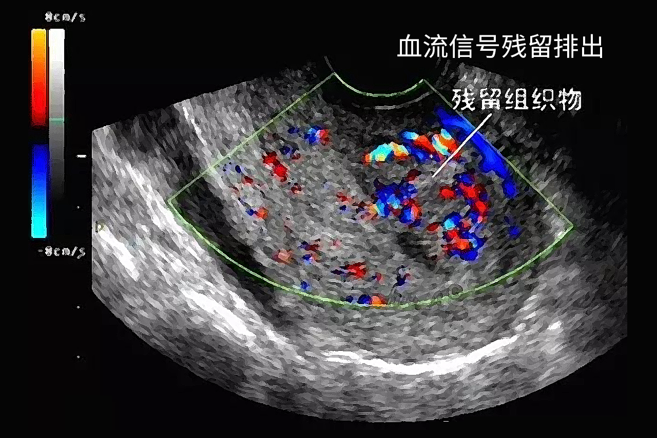 血流信号残留排出图片 有血流信号残留物不出血的原因