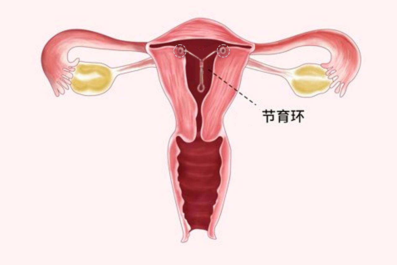 带环长肉上的图片（环上长肉对身体有害吗）