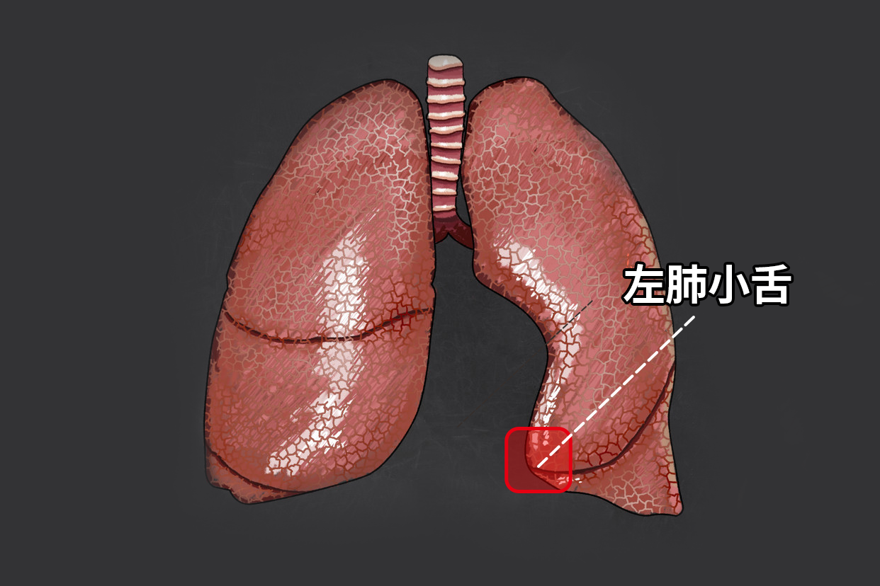 左肺小舌图片（左肺小舌在什么位置）