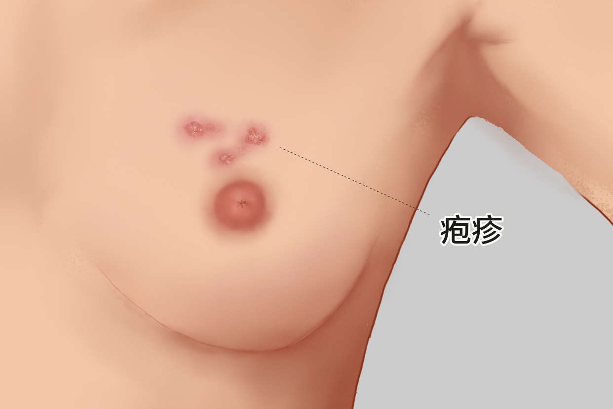 女性乳房长疱疹图样 乳房上长疱疹是否癌变