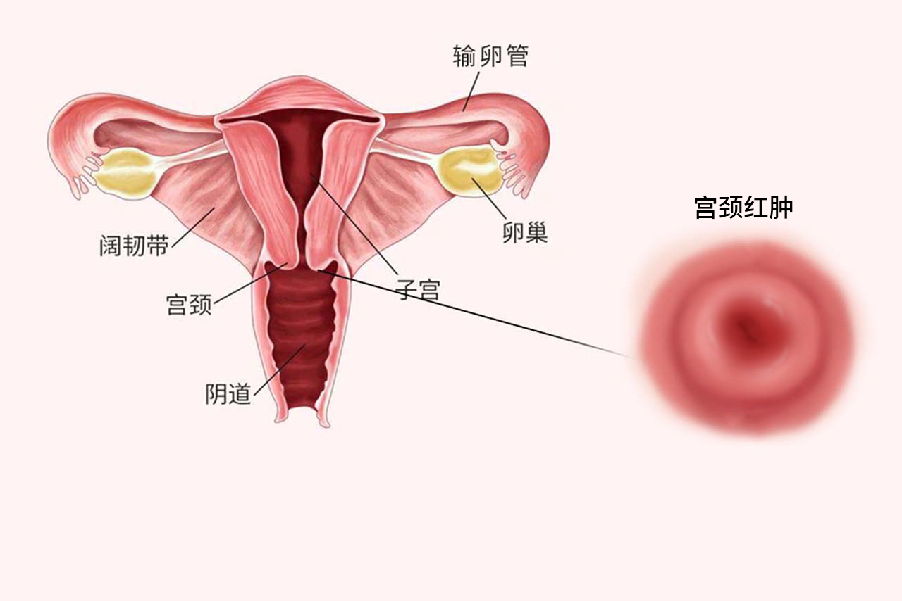 宫颈红肿图片