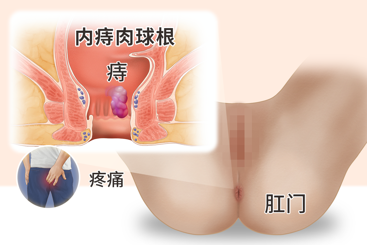 痔疮肉球有根筋疼是肉球根吗图片