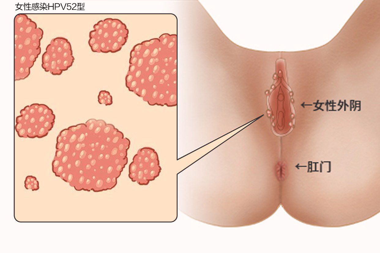 hpv52疣体长什么样